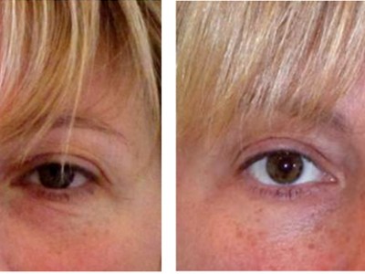 non surgical brow lifts