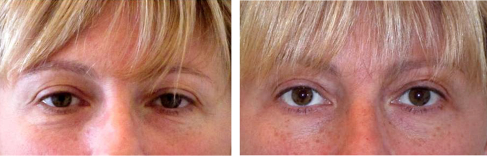 non surgical brow lifts