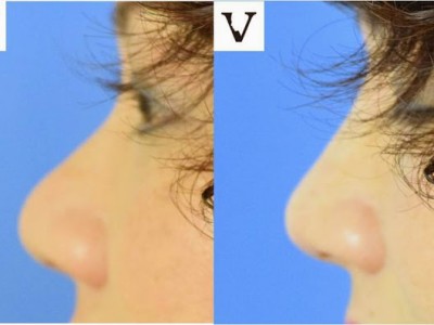 bulbous tip nose correction