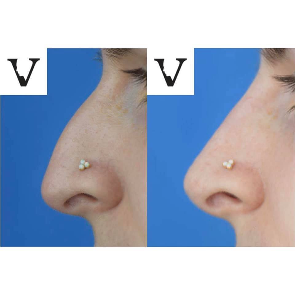 Non surgical nose job without surgery