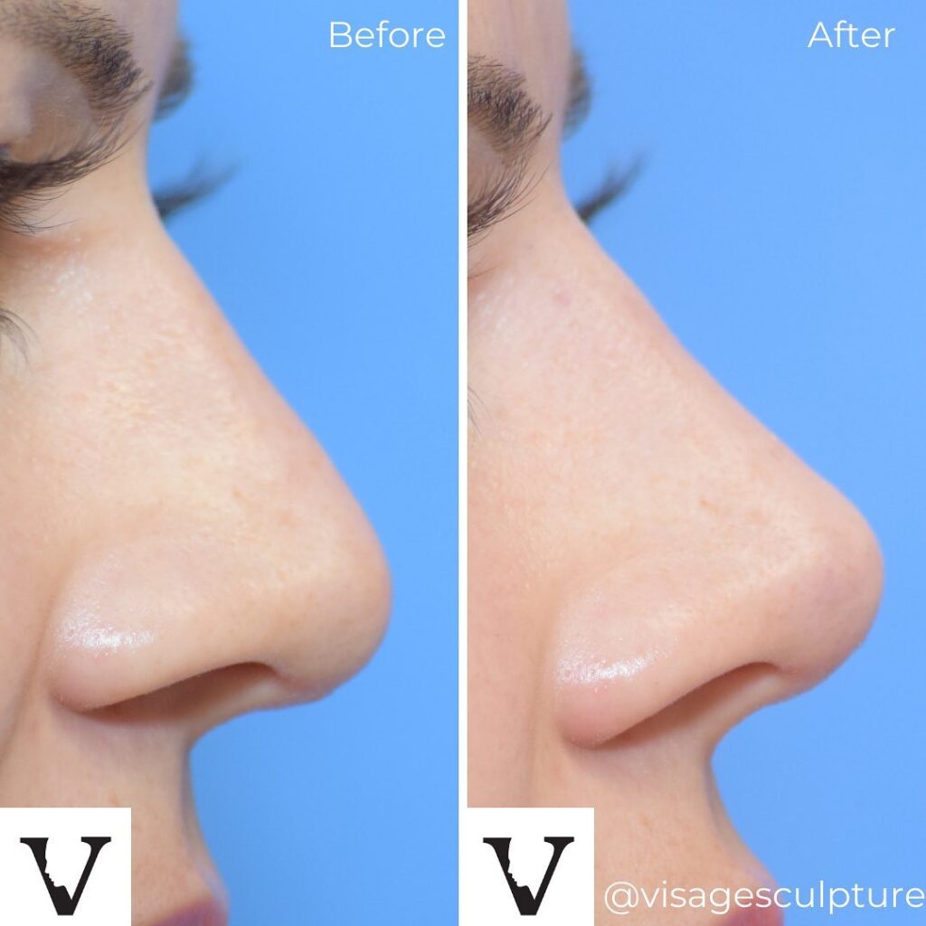 The Art of Nose Slimming with Muscle Relaxants: A Non-Surgical Marvel -  Advanced Cosmetic Medicine
