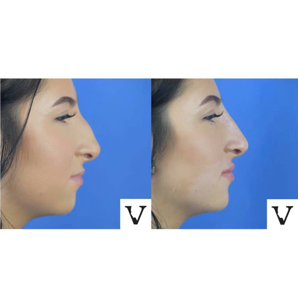 asymmetrical face correction