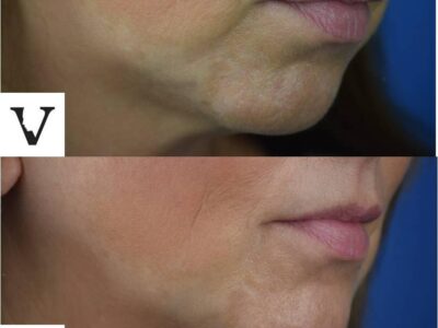 Jaw Reduction Surgery