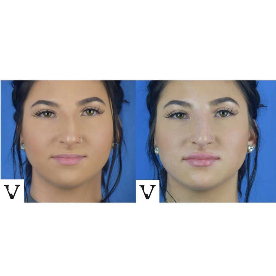 Asymmetrical Face Correction